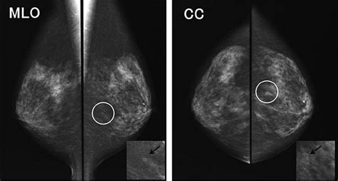 微細石灰化の集簇|乳房トモシンセシスにお け 集簇性石灰化症例の検討